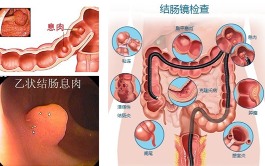 肠胃不好便血怎么回事