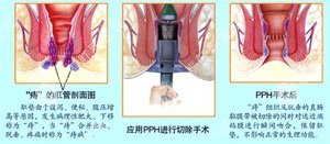 肛门出血是什么原因