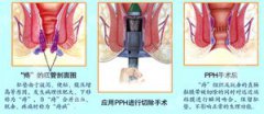 泉州市混合痔在生活中发作的病因