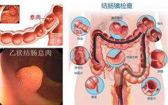 内痔和外痔的区别在哪里？【泉州