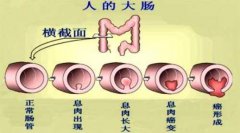 结肠炎患者的六忌_百度新闻